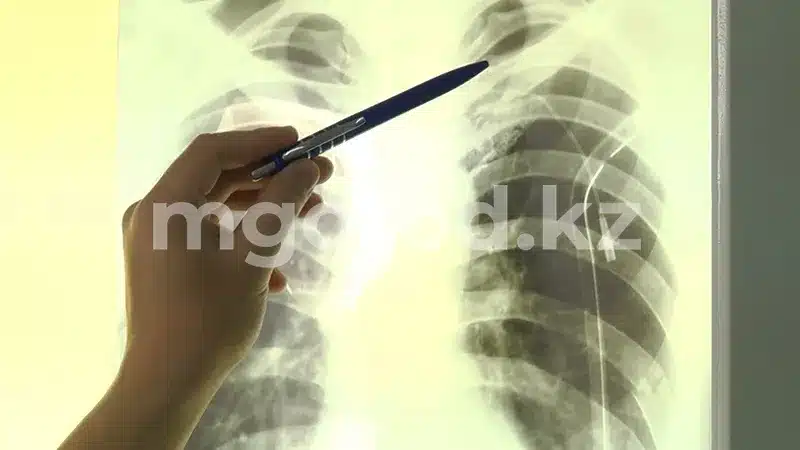 В ЗКО снизилась заболеваемость туберкулезом